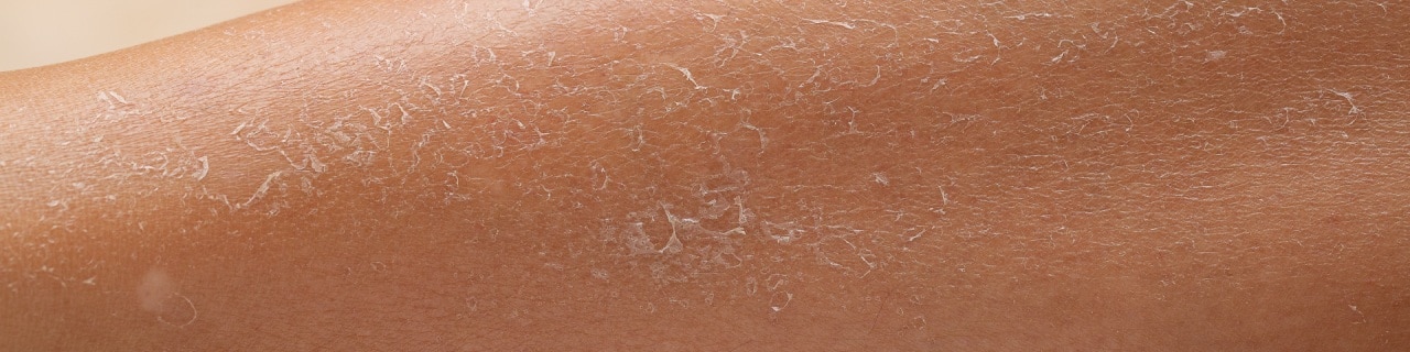 Imagem de pele descamando, sugerindo ressecamento e a necessidade de hidratação.
